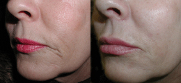 Restylane® Before and After | New Albany IN, St. Matthews KY