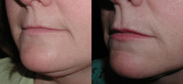 Restylane® Before and After | New Albany IN, St. Matthews KY