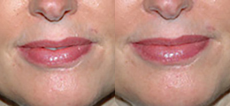 Restylane® Before and After | New Albany IN, St. Matthews KY