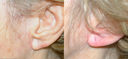 Restylane® Before and After | New Albany IN, St. Matthews KY