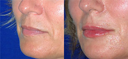 Restylane® Before and After | New Albany IN, St. Matthews KY