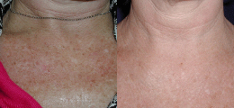 Skin Rejuvenation Gallery