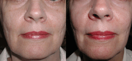 Skin Rejuvenation Before and After | New Albany IN, St. Matthews KY
