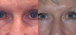 Skin Rejuvenation Before and After | New Albany IN, St. Matthews KY