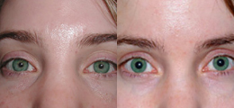 Skin Rejuvenation Before and After | New Albany IN, St. Matthews KY