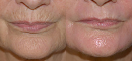 Skin Rejuvenation Before and After | New Albany IN, St. Matthews KY