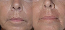 Skin Rejuvenation Before and After | New Albany IN, St. Matthews KY