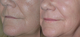 Skin Rejuvenation Before and After | New Albany IN, St. Matthews KY