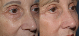 Skin Rejuvenation Before and After | New Albany IN, St. Matthews KY