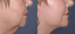 Facelift Before and After | New Albany IN, St. Matthews KY