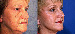 Facelift Before and After | New Albany IN, St. Matthews KY