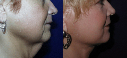 Facelift Before and After | New Albany IN, St. Matthews KY