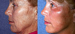 Facelift Before and After | New Albany IN, St. Matthews KY