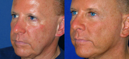 Facelift Before and After | New Albany IN, St. Matthews KY