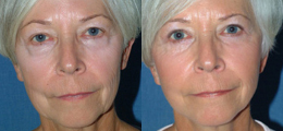 Facelift / Neck Lift Gallery
