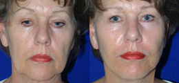 Facelift Before and After | New Albany IN, St. Matthews KY