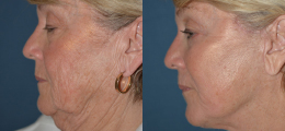 Facelift Before and After | New Albany IN, St. Matthews KY