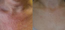 Laser Procedures Before and After | New Albany IN, St. Matthews KY