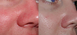 Laser Procedures Before and After | New Albany IN, St. Matthews KY
