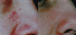 Laser Procedures Before and After | New Albany IN, St. Matthews KY