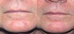 Laser Procedures Before and After | New Albany IN, St. Matthews KY