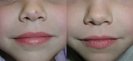Laser Procedures Before and After | New Albany IN, St. Matthews KY