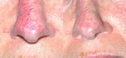 Laser Procedures Before and After | New Albany IN, St. Matthews KY
