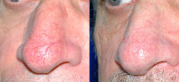 Laser Procedures Before and After | New Albany IN, St. Matthews KY