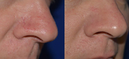 Laser Procedures Before and After | New Albany IN, St. Matthews KY