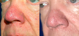 Laser Procedures Before and After | New Albany IN, St. Matthews KY
