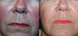 Laser Procedures Before and After | New Albany IN, St. Matthews KY