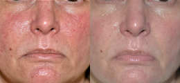 Laser Procedures Before and After | New Albany IN, St. Matthews KY