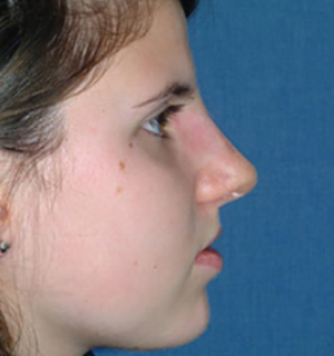 Nasal Surgery After