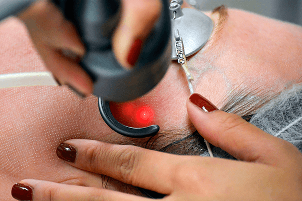 Laser and Light Skin Treatments
