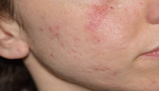 acne-vascular-scar