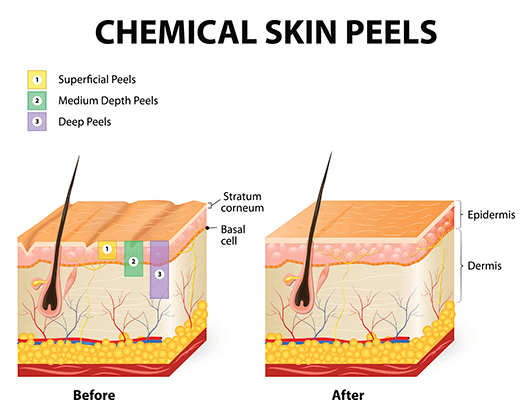 Chemical Skin Peels Example