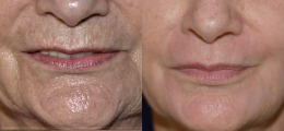 Chemical Peel Before and After | New Albany IN, St. Matthews KY