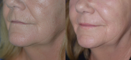 Chemical Peel Before and After | New Albany IN, St. Matthews KY