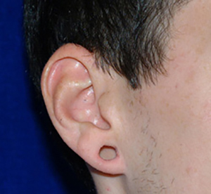 Before Ear Gauge Repair