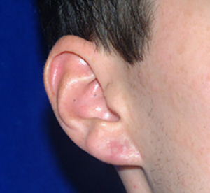 After Ear Gauge Repair