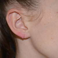Before Ear Surgery