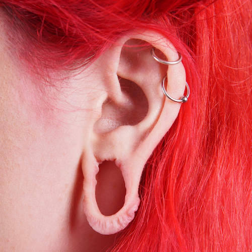 Earlobe gauge repair - Chatham Facial Plastic Surgery