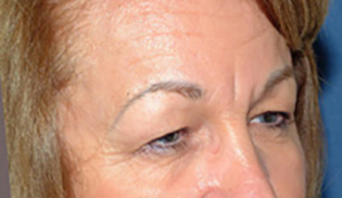 Before Eyelid Lift