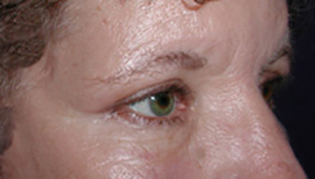 After Eyelid Lift