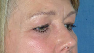 Before Eyelid Lift