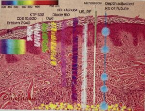 fractional laser example