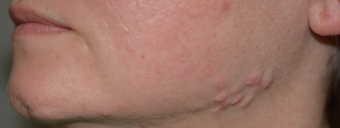 keloid-depressed-scar