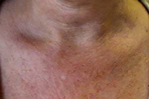 Before IPL Procedures