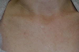 After IPL Procedures