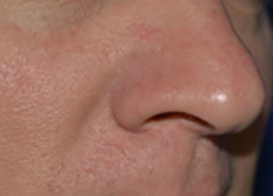 After Varilight Laser Treatment